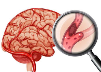 Aumentan los casos de ACV en adultos jóvenes y mujeres: ¿Cuáles son las causas?