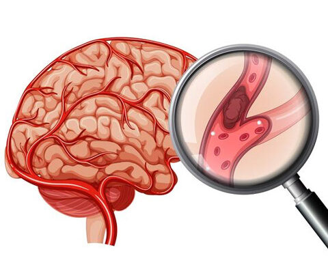 Aumentan los casos de ACV en adultos jóvenes y mujeres: ¿Cuáles son las causas?